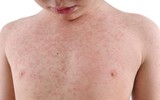 [ẢNH] Những loại bệnh dịch phổ biến do thời tiết ở Việt Nam